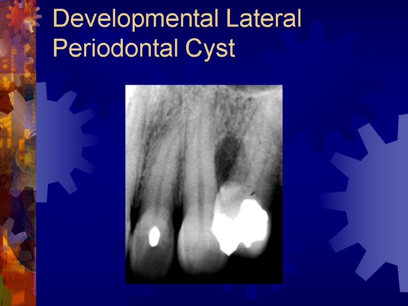 Developmental Lateral Periodontal Cyst